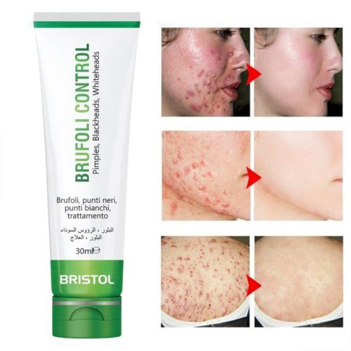 BRUFOLI CONTROL Pimples, BlackHeads, WhiteHeads, Acne (30ml)